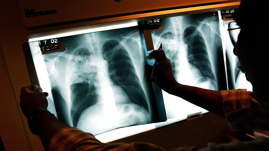 2 active tuberculosis cases traced to San Francisco strip club — KTVU FOX 2 Bay Area, Carmel-by-the-Sea Health news